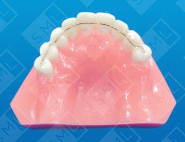 Wire Composite Splint Intra Coronal Splint Orthodontic Appliances wire-composite-splint-intra-coronal-splint-orthodontic-appliances